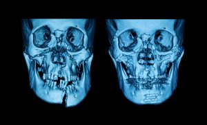 facial injury x-ray